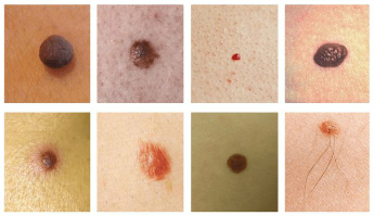 The most common blemishes on the skin – this is me and papilloma (wart)
