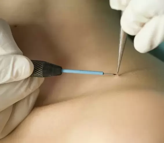 Removal of papilloma by electrocoagulation