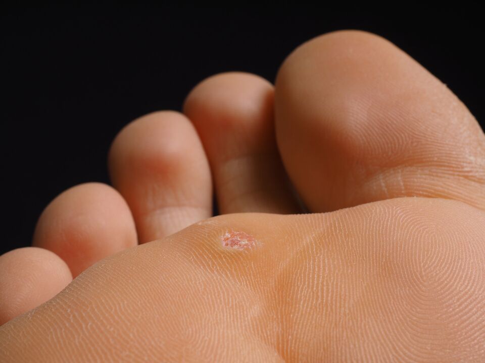 what a plantar wart looks like