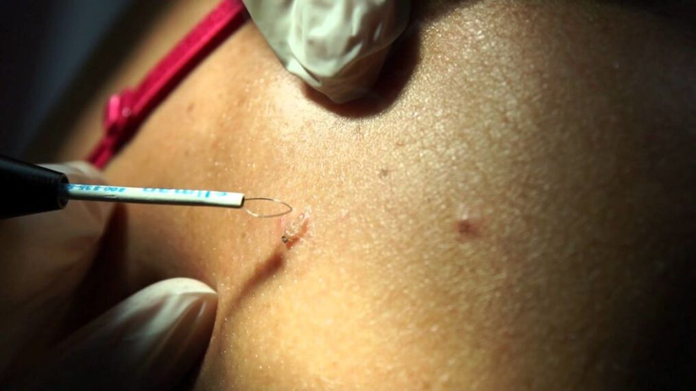 radiowave removal of the papilloma
