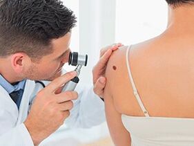 the doctor examines the papilloma for recommended removal with medication