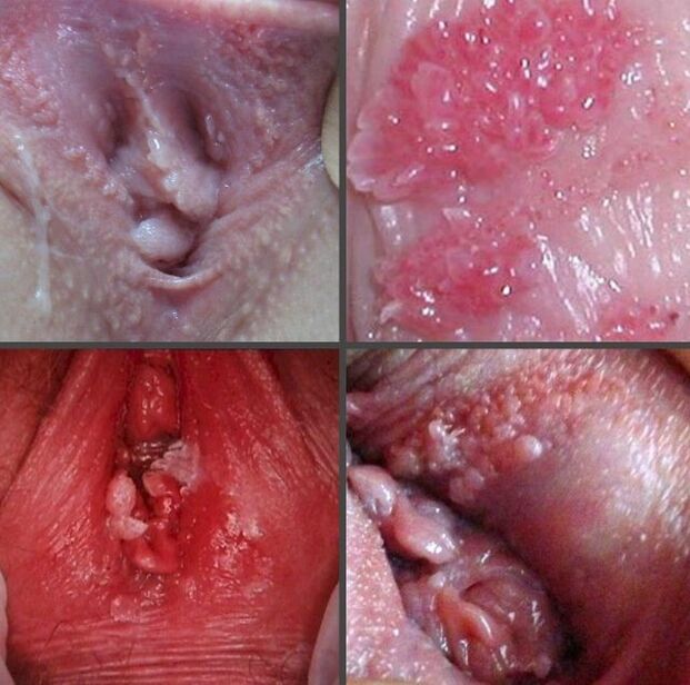 Close papillomas in the vagina