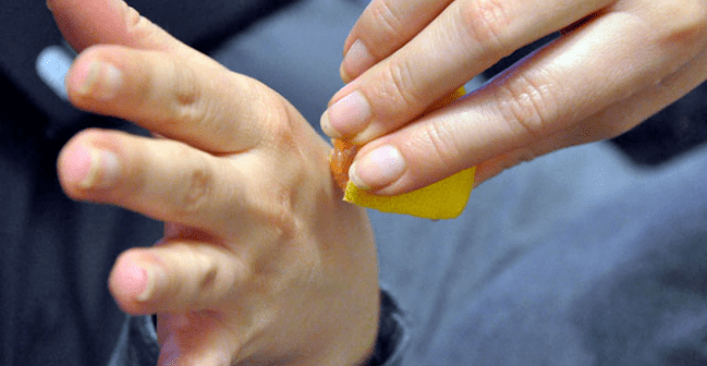 removal of warts on the hand
