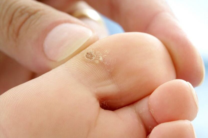 wart on the toes