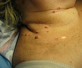 human papillomavirus of the neck