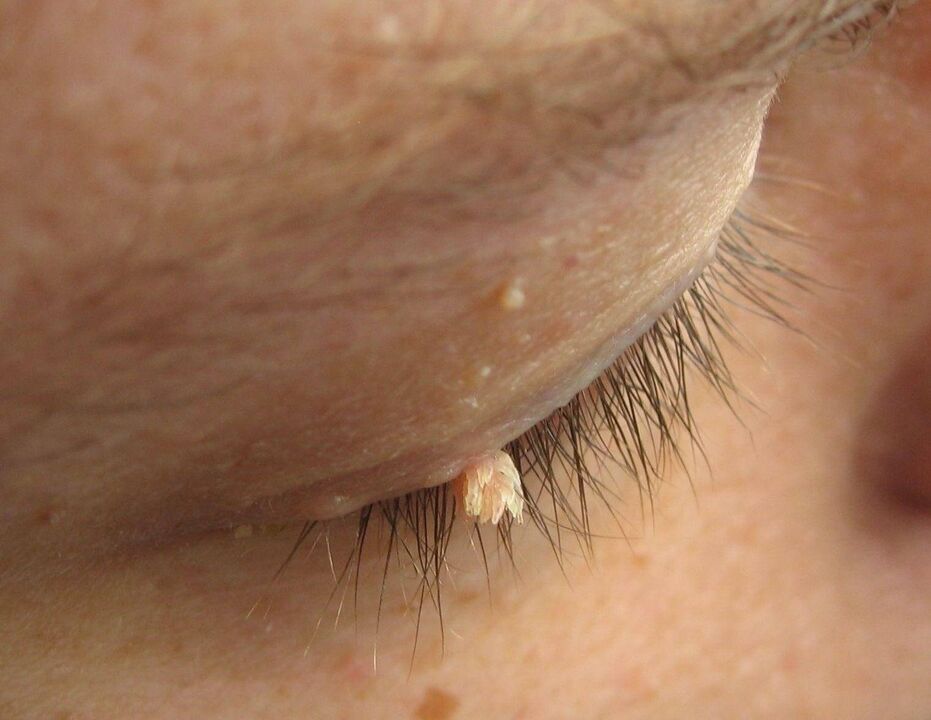 eyelid papillomas
