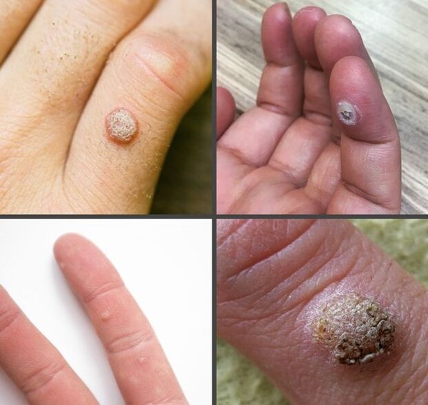 Common types of finger warts