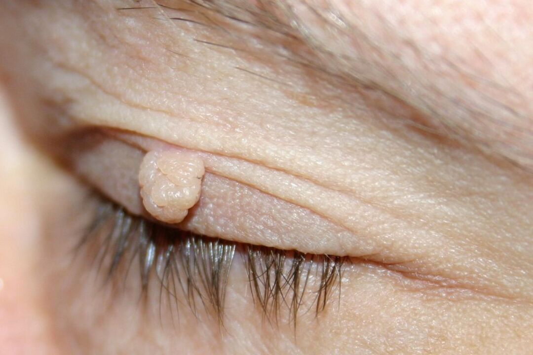 symptoms of eyelid papilloma