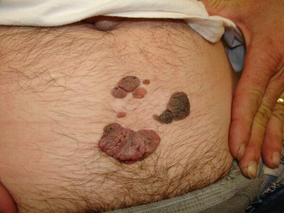 papillomas on the abdomen of a man