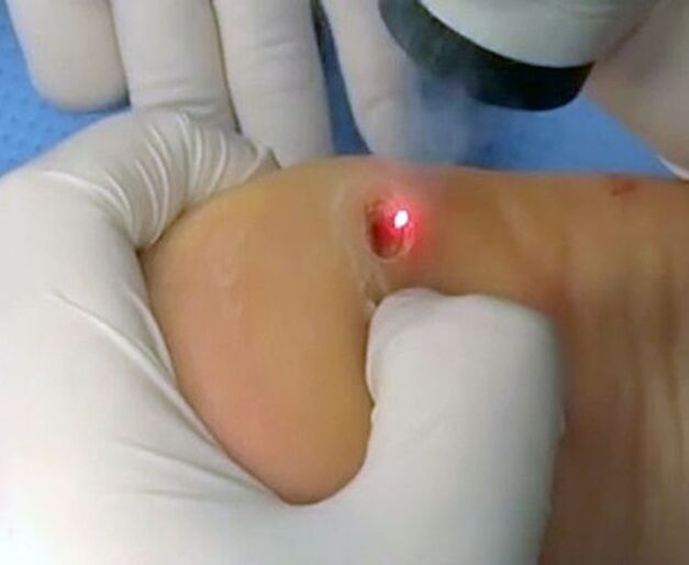 The procedure to remove warts on the heel using a laser