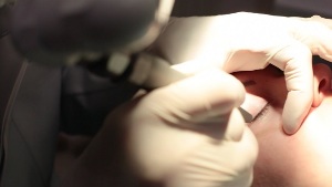 Laser removal of papilloma on the eyelid